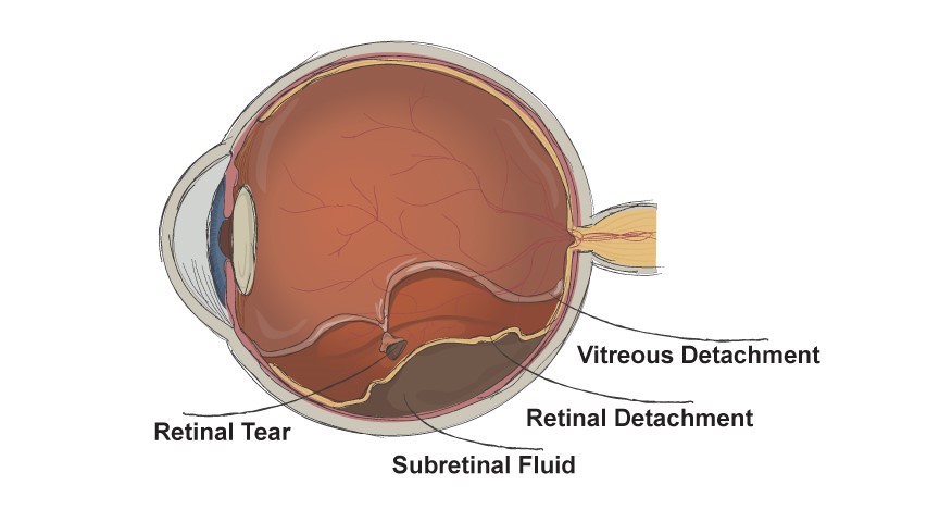 post retina detachment surgery